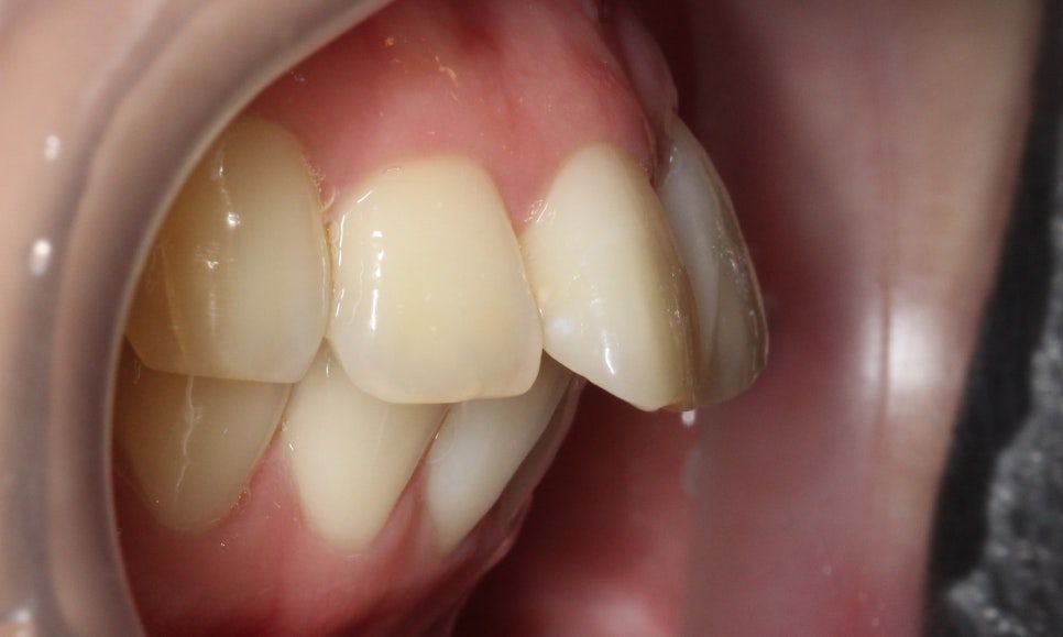 대치동치과 입툭튀 집어넣는 교정 관련 이미지 3