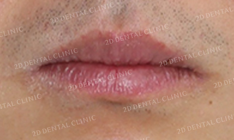 돌출앞니 교정, 튀어나온 입을 넣어보자! by.투디치과(2D치과) 관련 이미지 13