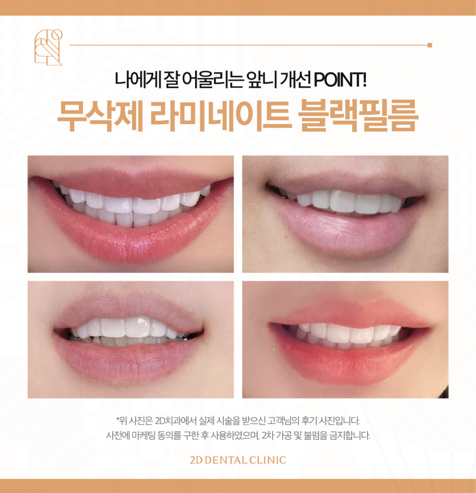 무삭제라미네이트비용 앞니성형 이렇게 결정됩니다 관련 이미지 7