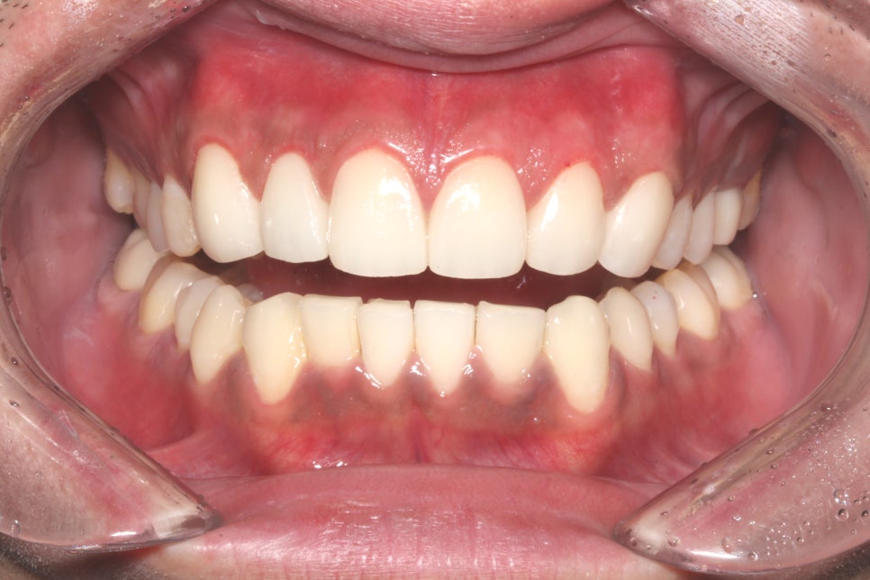 평생 소장! 앞니보철은 자연스러운 2D치과(투디치과) BLINX(블링스)로! 관련 이미지 9