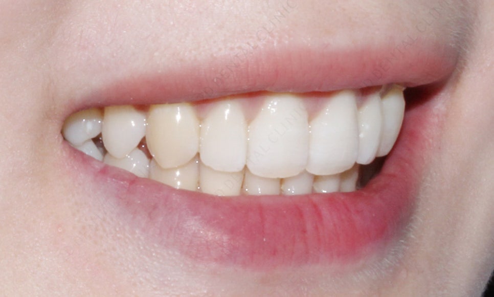 덧니치아 앞니교정 4개월 교정 완료! by. 투디치과(2D치과) 관련 이미지 10