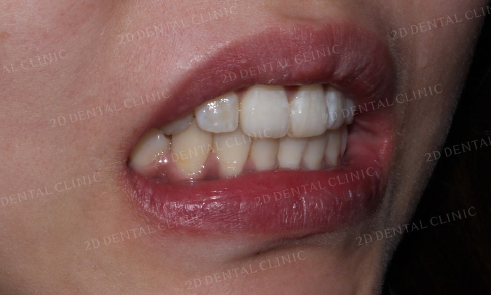 [2D교정] 나비치아, 앞니교정 설측교정으로 빠르게 하는 방법! by.2D치과(투디치과) 관련 이미지 12