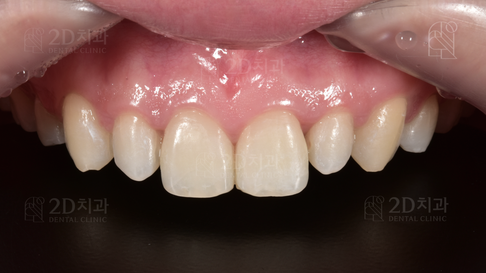 왜소치 라미네이트  신논현역 2D치과 관련 이미지 5