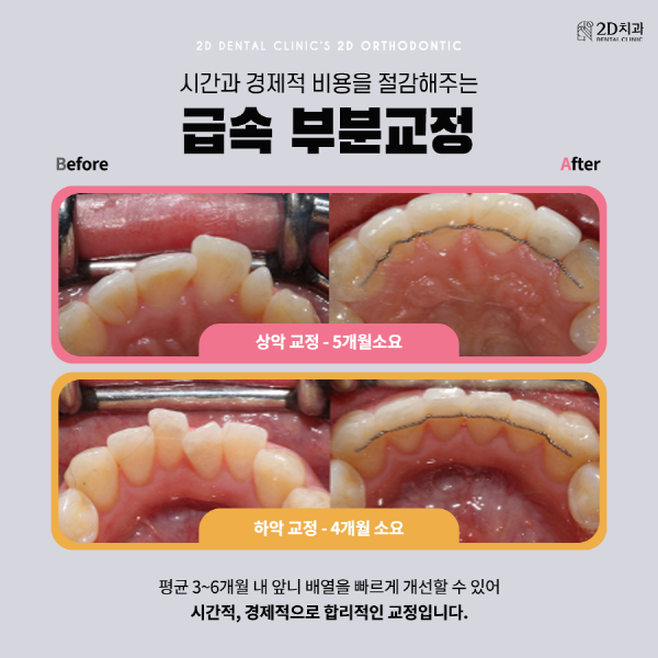 바쁜데 치아 교정 가능? 2D의 앞니교정은 가능! 관련 이미지 4