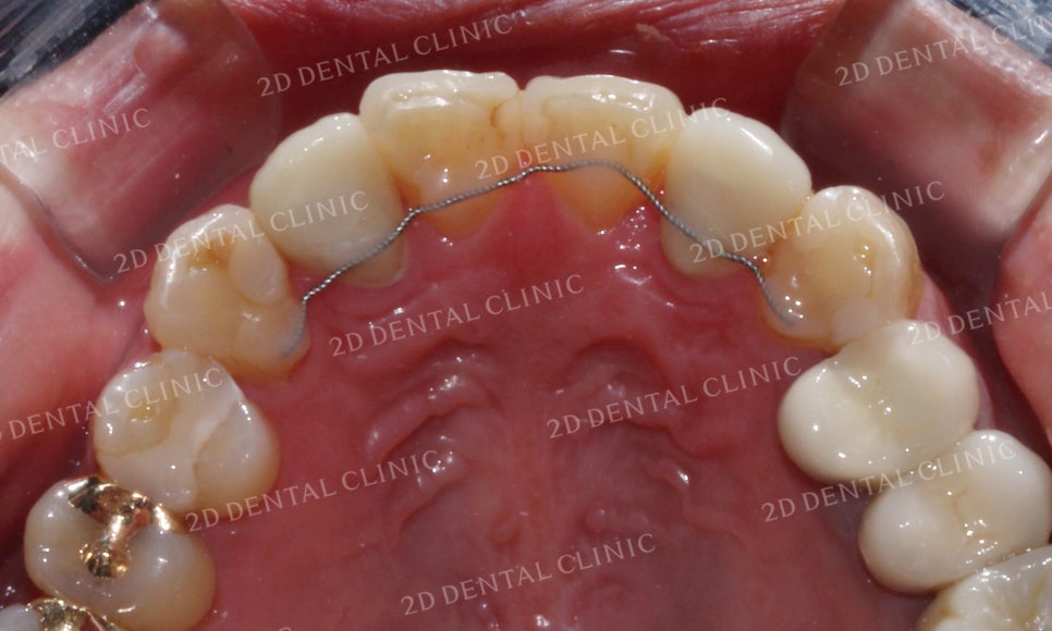 [2D교정] 나비치아교정을 2D교정 장치로 빠르게 완성하기! by.2D치과(투디치과) 관련 이미지 16