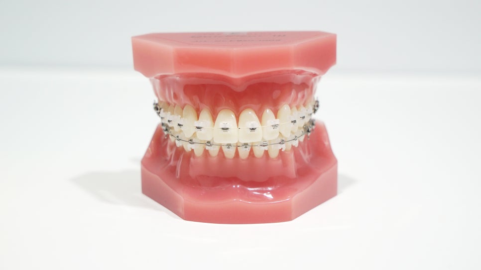 2D(투디)치과!치아교정!클리피씨교정,순측 교정?설측교정? 관련 이미지 7