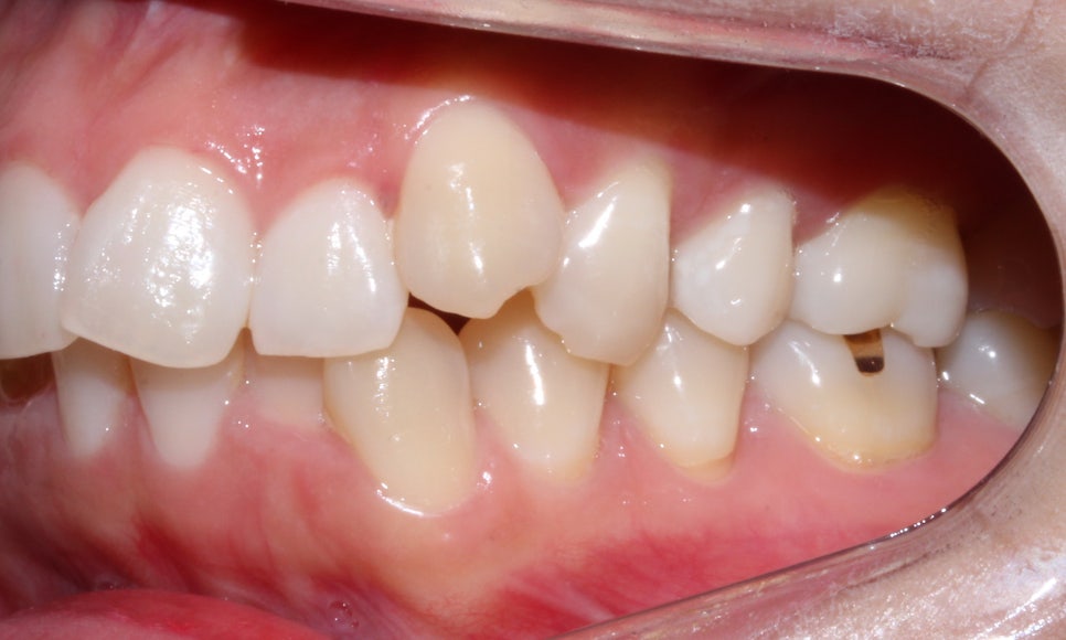 돌출입 탈출기! 덧니 교정도 문제없어! by.투디치과(2D치과) 관련 이미지 7