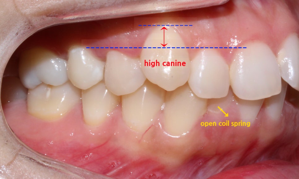 역삼역치과 송곳니덧니 crowding Case 관련 이미지 4