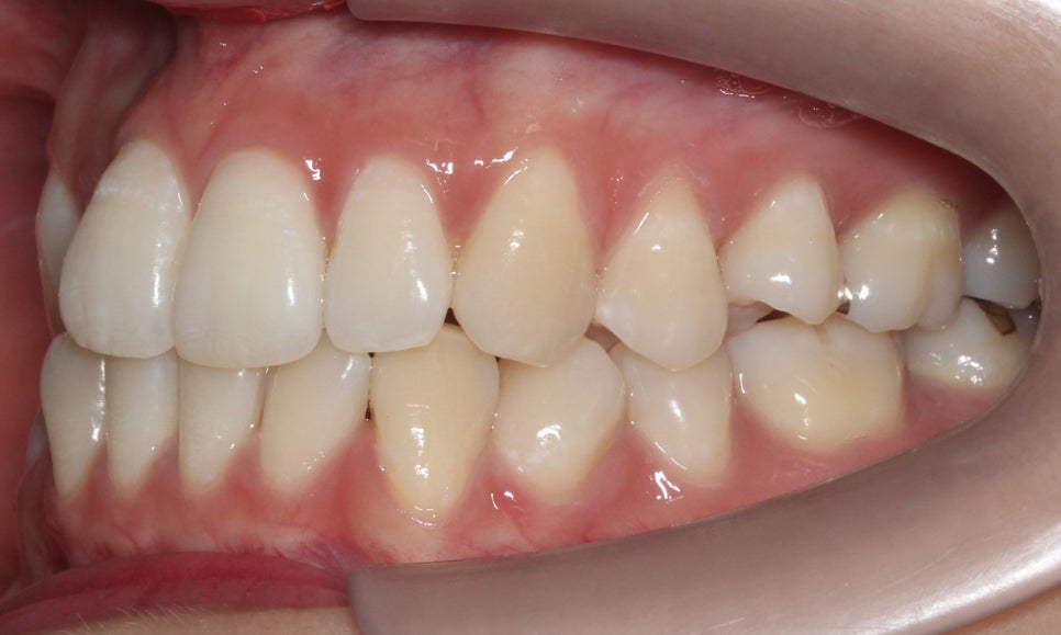 신논현치과 자가결찰브라켓 장점 관련 이미지 6