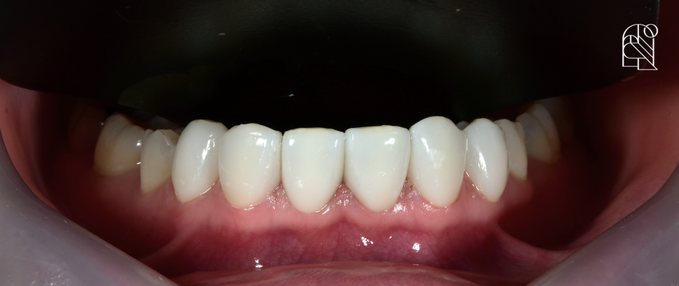앞니깨짐 (앞니파절) 치료방법 세 가지 - 레진, 라미네이트, 크라운 관련 이미지 6