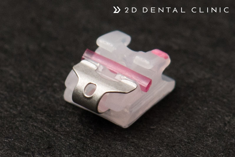 앞니 부분교정 전체교정 비교, 강남 2D치과 관련 이미지 9