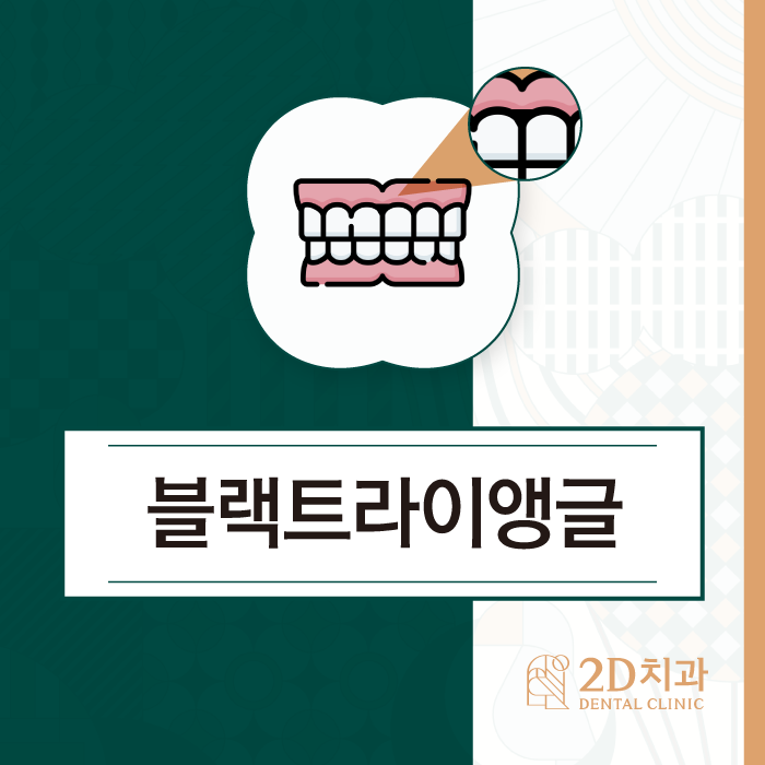 치아 사이 까만 틈, 블랙트라이앵글이란? 관련 이미지 1