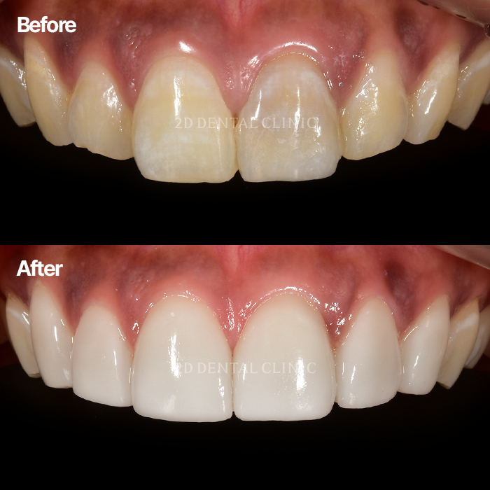 무삭제라미네이트 치아삭제에 대한 부담 없는 후기 관련 이미지 2