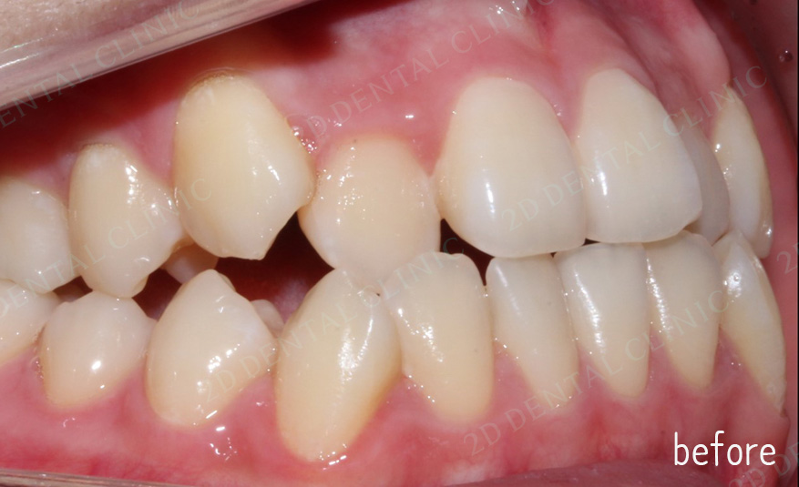 우디의 교정일기ㅣ덧니 치아교정 후기 (feat.부정교합) 관련 이미지 6