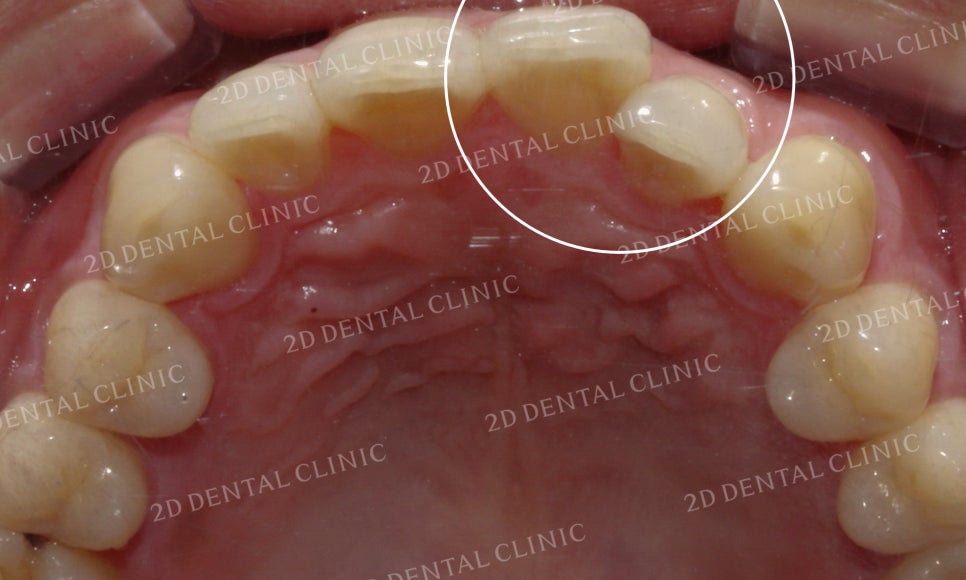 틀어진 앞니를 전체 교정으로 바르게! by.투디치과(2D치과) 관련 이미지 17