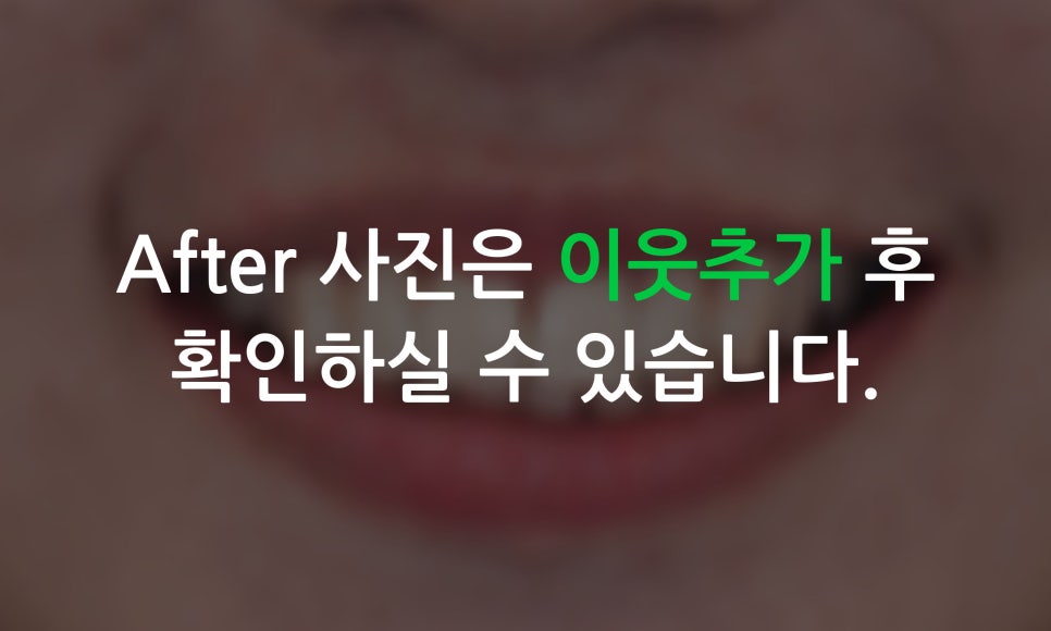 앞니틀어짐을 교정하는 방법은? (2D교정-설측교정) 관련 이미지 5