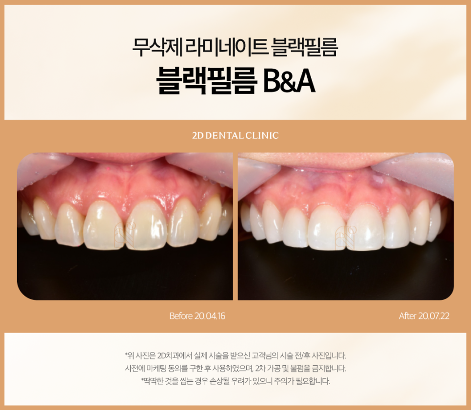 인천무삭제라미네이트 치아파절치료 5가지 꼭 확인하셔야 합니다 관련 이미지 6