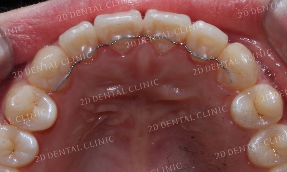 [앞니교정]토끼앞니교정, 부분교정으로 토끼이빨 탈출하기! by.투디치과(2D치과) 관련 이미지 14