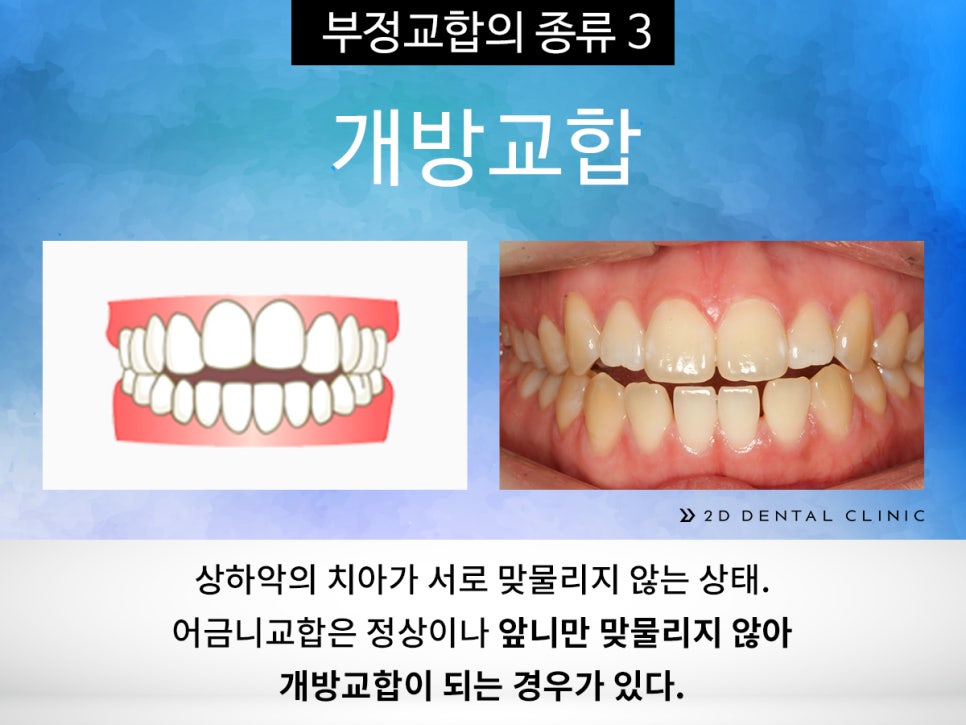 [교정상식] 부정교합 종류! 나는 어떤 케이스에 해당될까? 관련 이미지 6