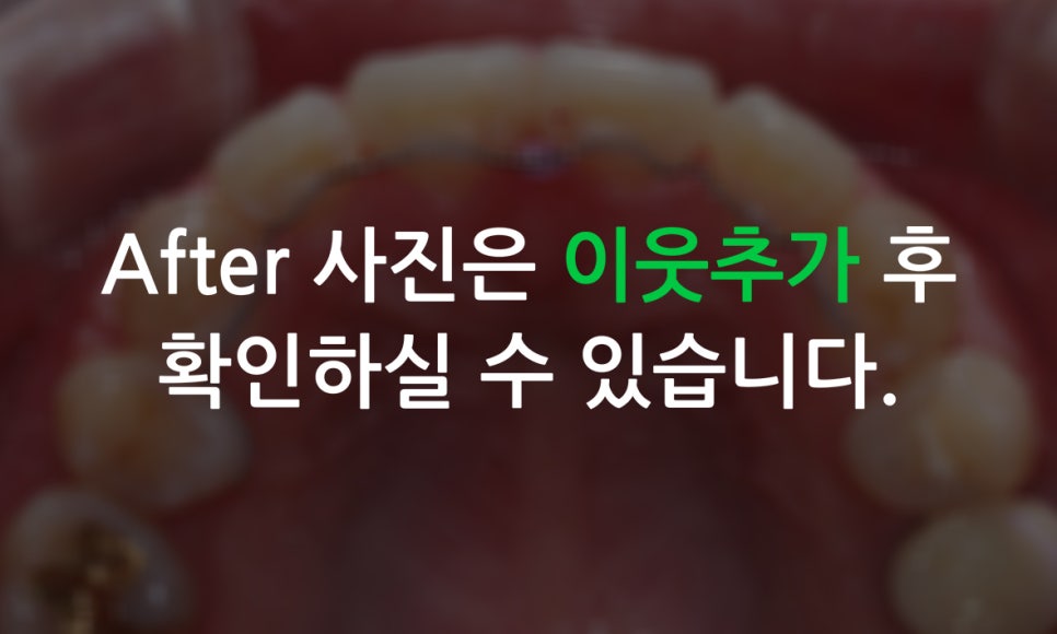 송곳니덧니 교정하는 방법! 관련 이미지 8