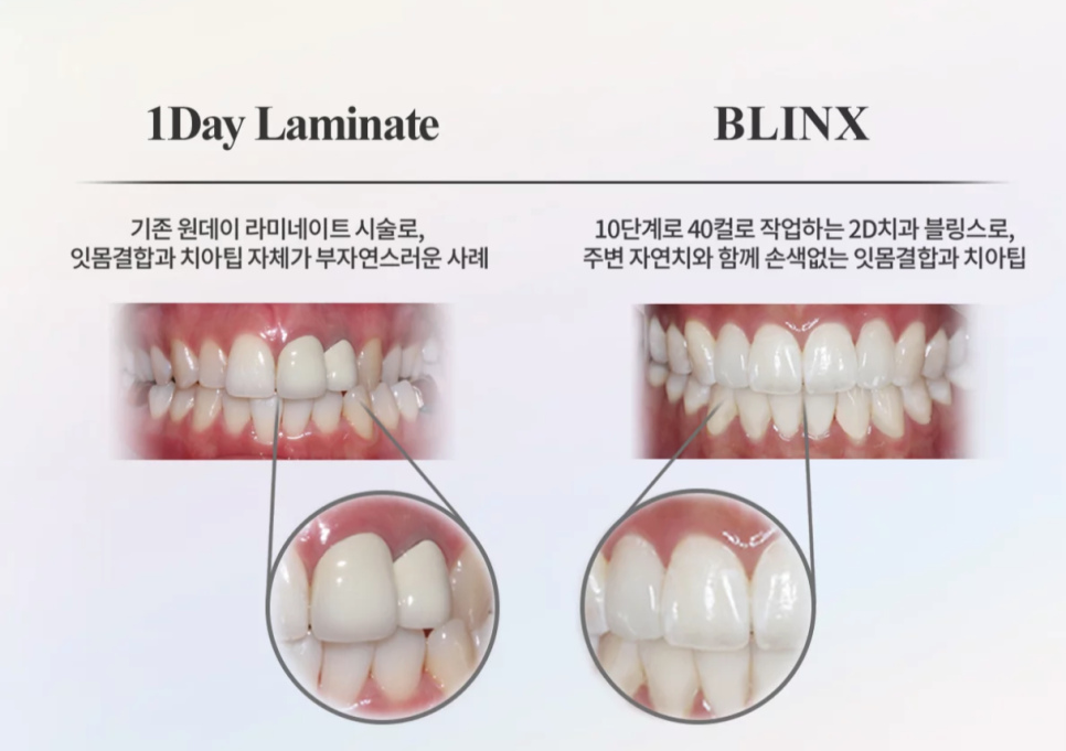 2D(투디)치과 블링스, 추천합니다!(깨진 앞니, 돌출앞니, 벌어진 앞니, 치아 노후, 치아 변색) 관련 이미지 11