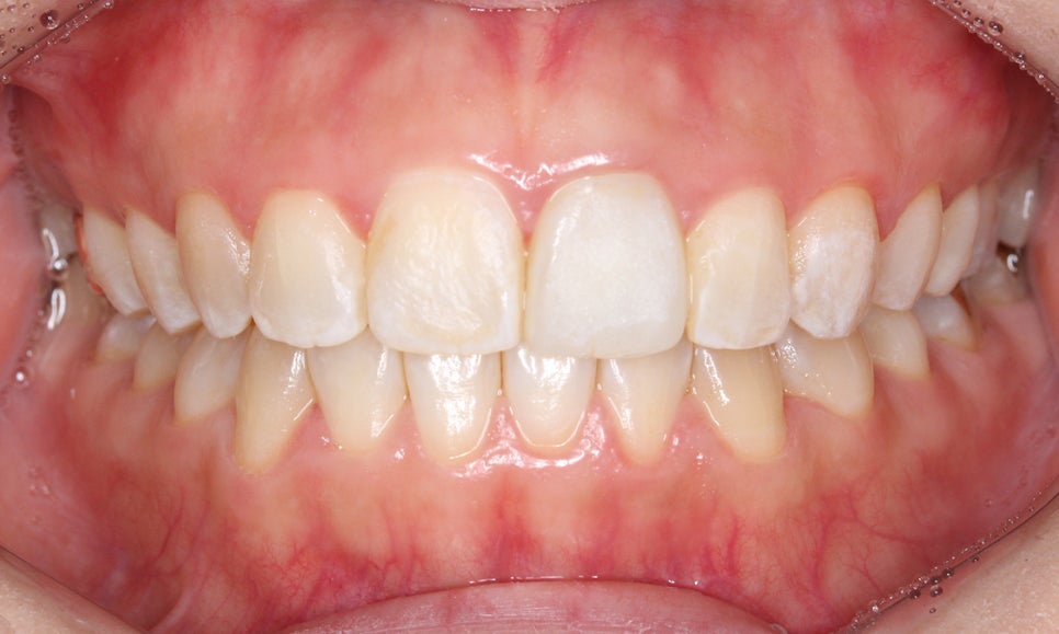 양악교정 송곳니교정 중심으로 관련 이미지 8