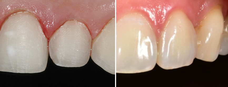 앞니왜소치 치아깨짐 무삭제라미네이트 블랙필름 관련 이미지 8