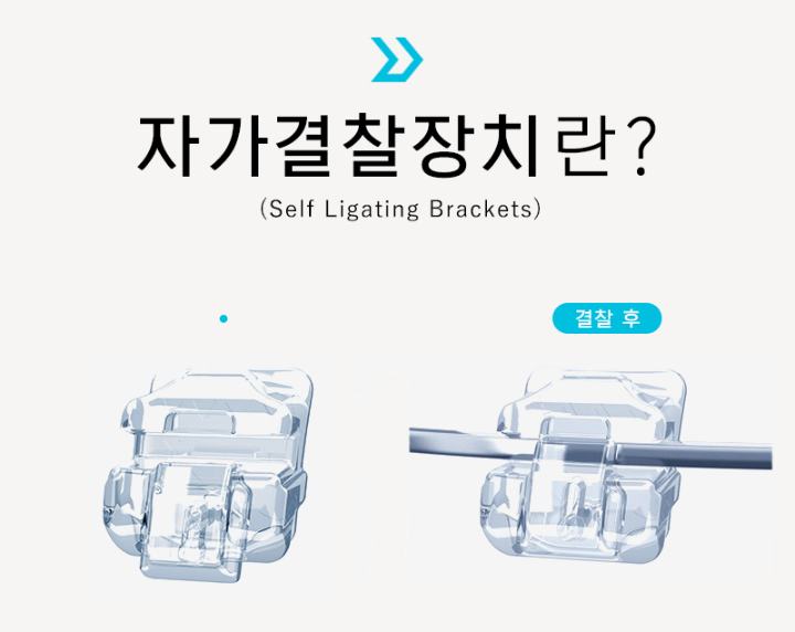 2D교정? 클리피씨? 자가결찰 브라켓! 강남 투디치과 관련 이미지 3