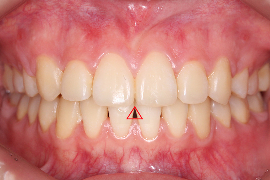입돌출 데이몬교정 Case1 관련 이미지 8