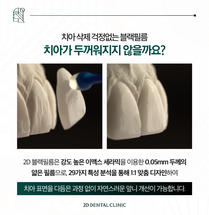 광주무삭제라미네이트 블랙필름으로 치아 반점 개선하기 관련 이미지 5
