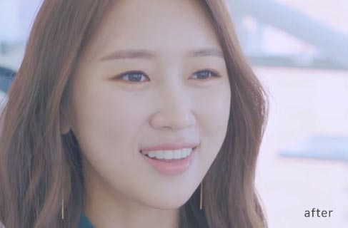 투디치과(2D치과)에서 직!접! 무삭제 쎄라필름을 한 리얼후기 관련 이미지 9
