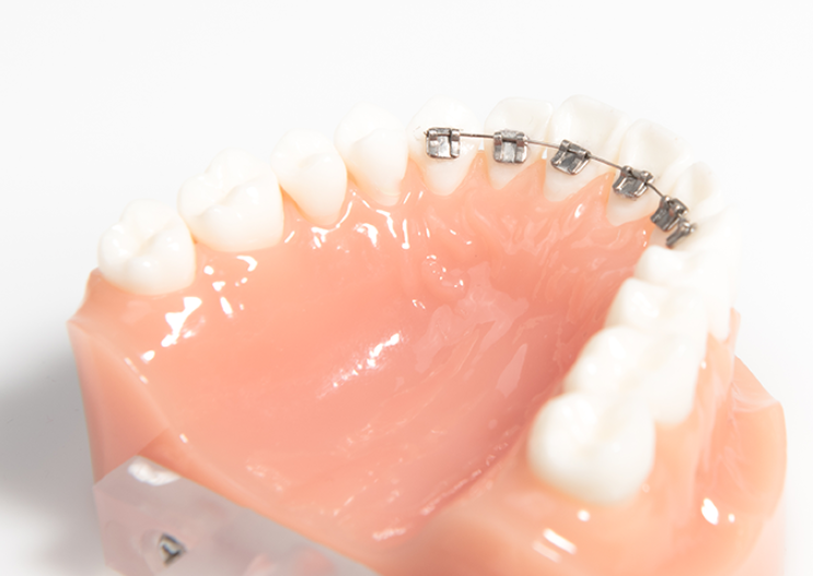 자연스러운 내 치아같은 무삭제라미네이트후기 관련 이미지 6