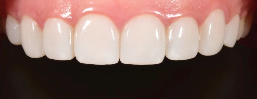 앞니 무삭제라미네이트 고객맞춤형 치아제작하는 블랙필름 관련 이미지 2