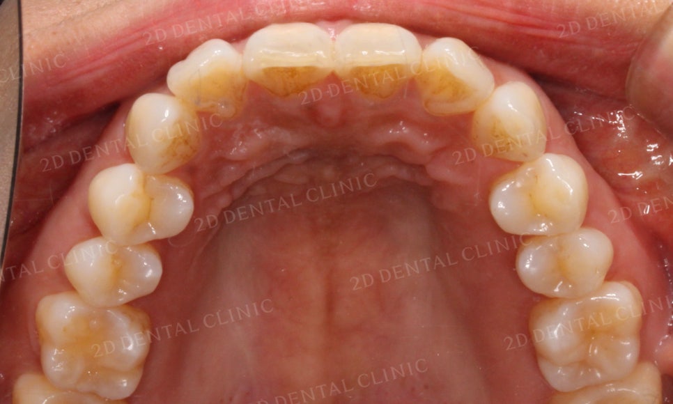 [부분교정] 틀어진 앞니, 부분교정으로 앞니교정하기! by.투디치과(2D치과) 관련 이미지 18