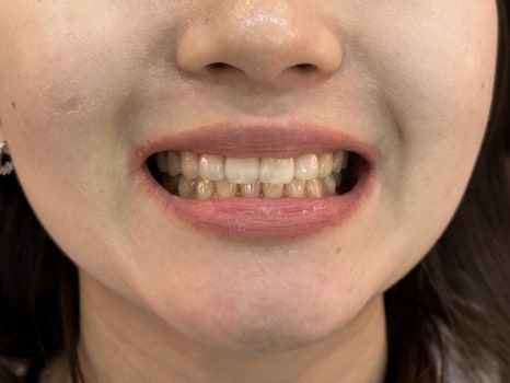 무삭제 라미네이트 개인의 치아디자인에 맞춘 단 하나밖에 없는 치아디자인 블랙필름 관련 이미지 10