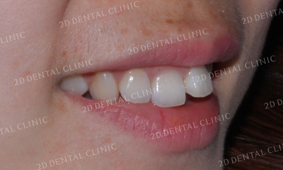 [투디교정] 덧니교정, 앞니교정으로 치열을 고르게! by.투디치과(2D치과) 관련 이미지 11