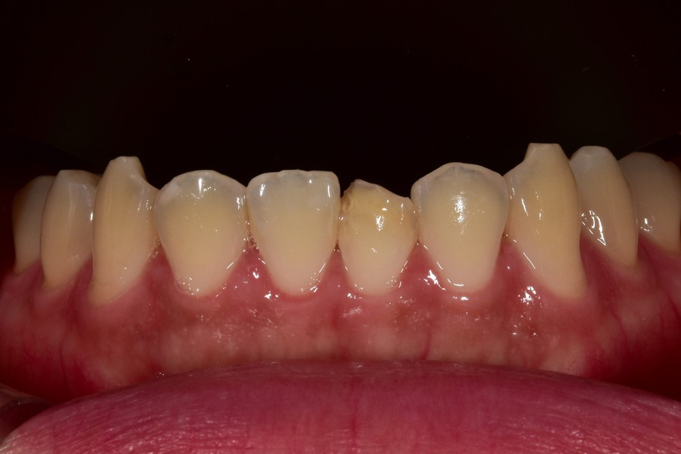 [투디치과] 블랙필름(비스포크) 치료의 다양한 사례 관련 이미지 18