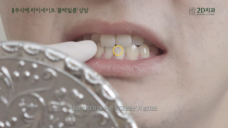 [블랙필름 상담받고 왔어요] #2 반대교합도 가능할까요? 관련 이미지 8