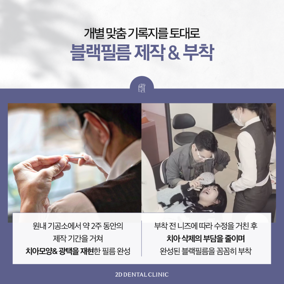 최준희라미네이트 치아착색 블랙필름으로 환해진 얼굴! 관련 이미지 5