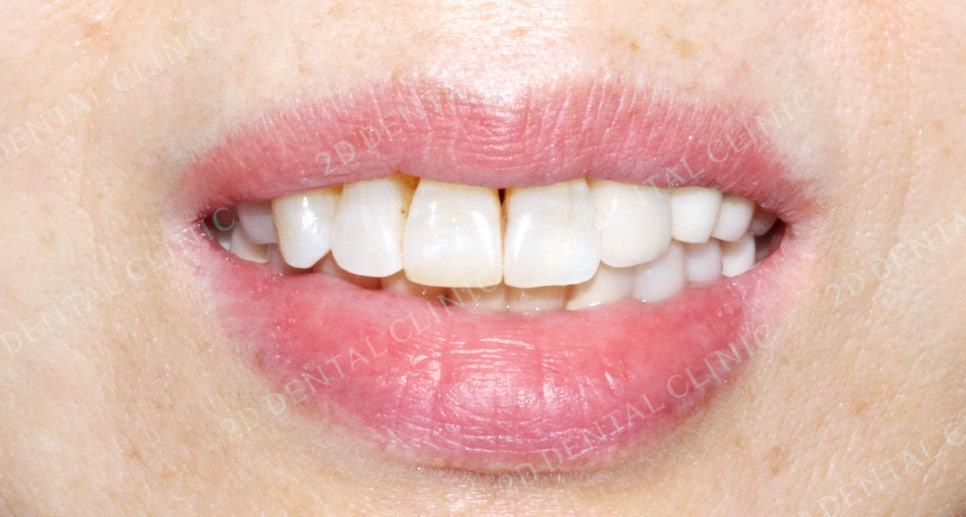 2D치과(투디치과) 교정일기 ㅣ 잇몸질환 예방되는 치아교정(feat.어머님교정) 관련 이미지 7