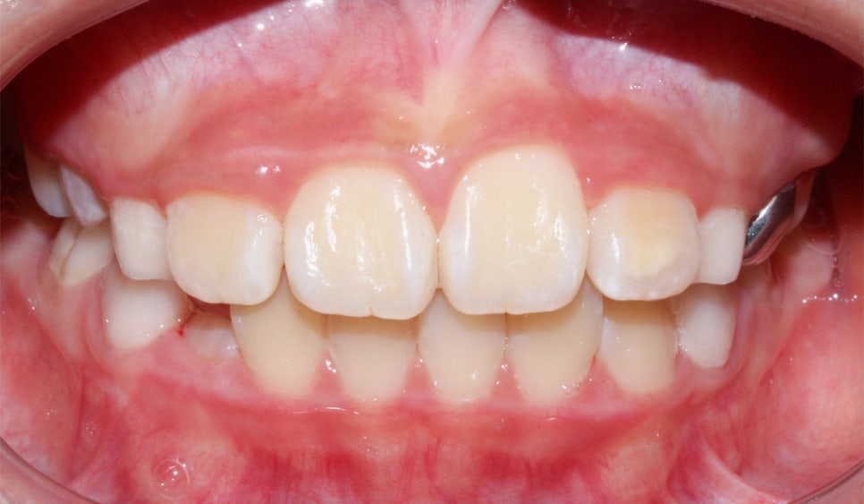 어린이 반대교합 덧니 교정으로 교정 끝! by. 투디치과(2D치과) 관련 이미지 7