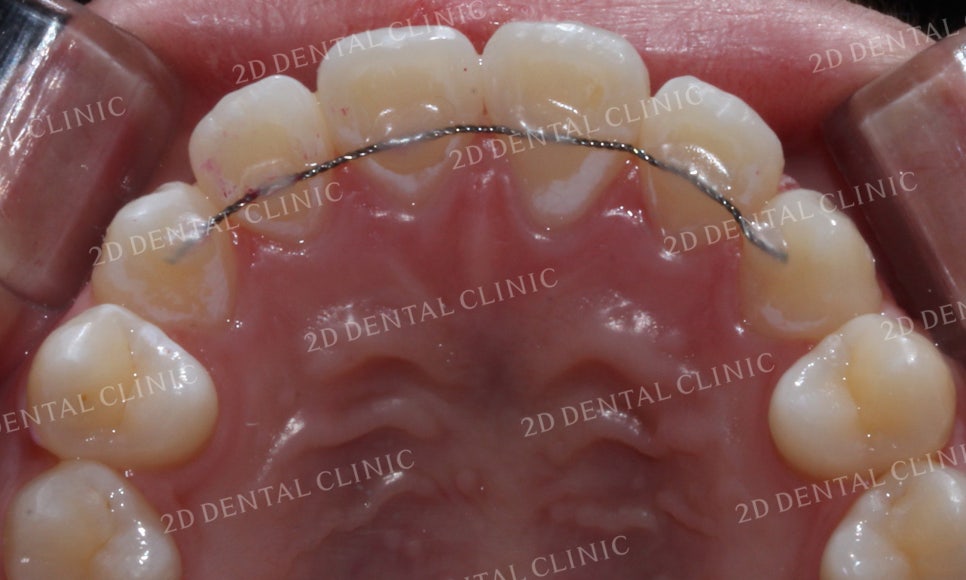 반대교합 치아교정, 앞니를 가지런하게! by.투디치과(2D치과) 관련 이미지 16
