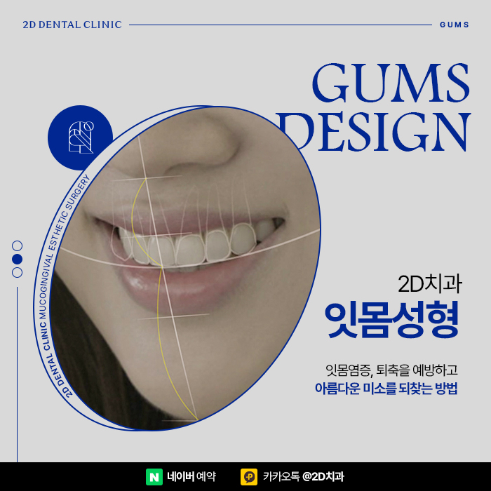 치아관리만큼 중요한 잇몸관리, 잇몸염증, 잇몸퇴축 예방하는 방법, 신논현 잇몸성형 관련 이미지 1