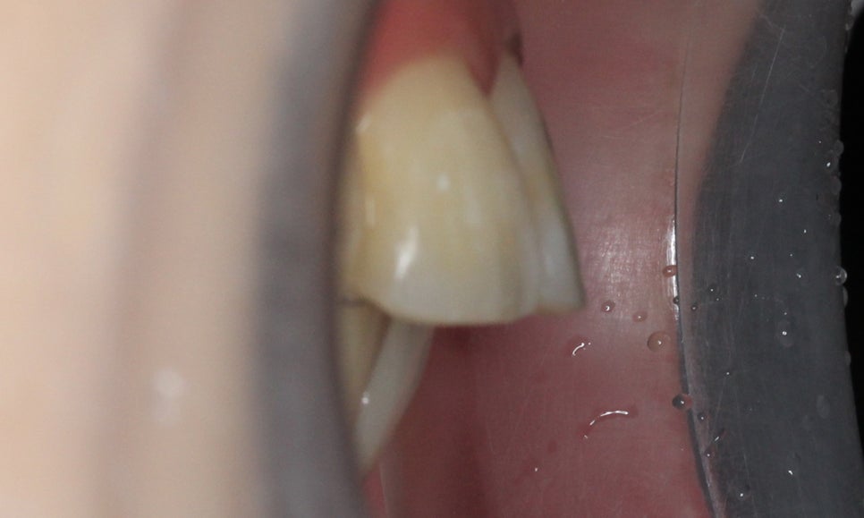 대치동치과 입툭튀 집어넣는 교정 관련 이미지 10