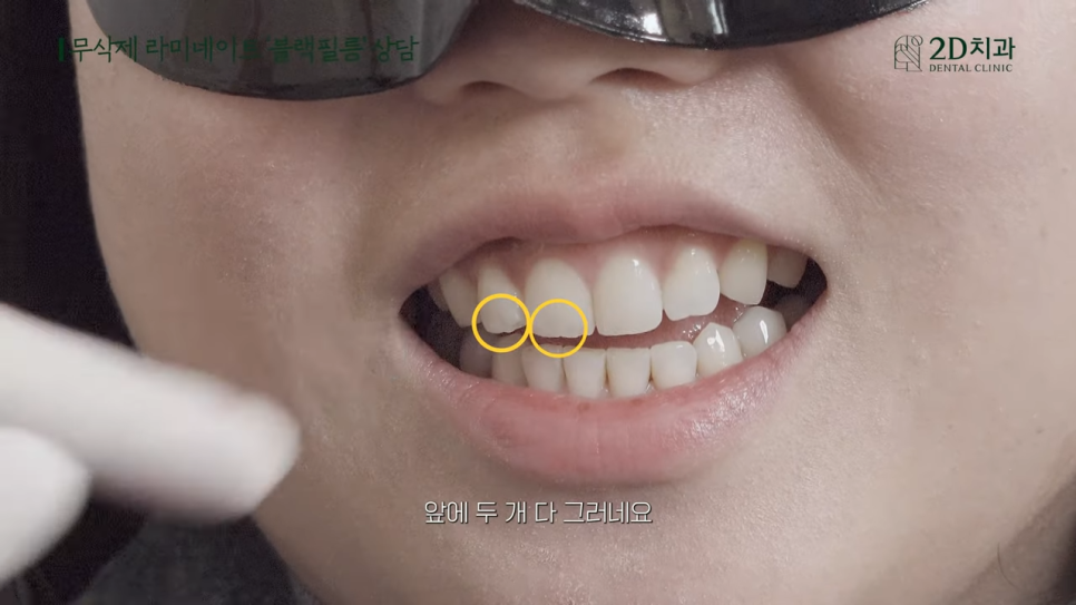 [블랙필름 상담받고 왔어요] #3 앞니가 깨졌어요 관련 이미지 22