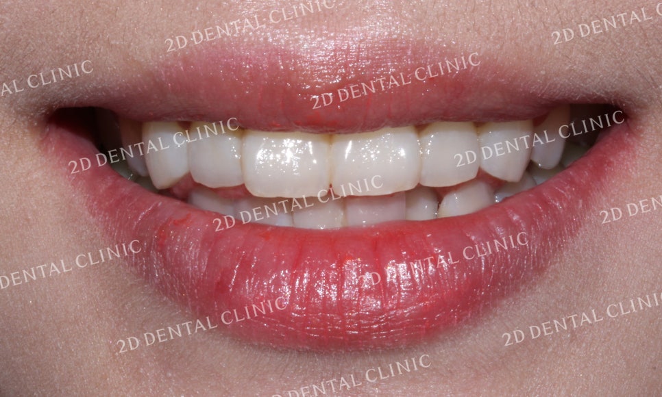 [투디교정] 덧니치아교정, 부분교정으로 쉽고 빠르게! by.투디치과(2D치과) 관련 이미지 9