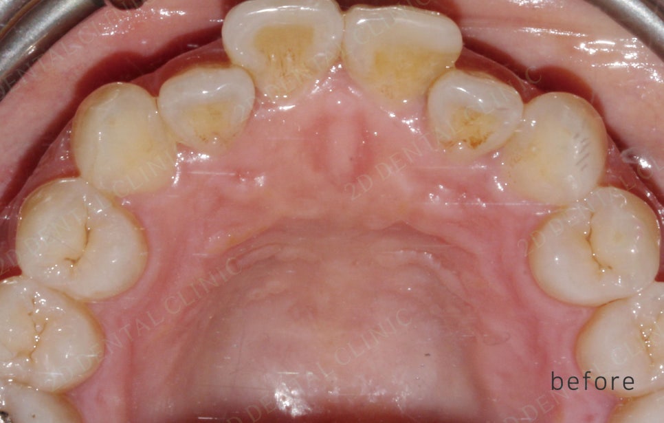 2D치과(투디치과) 교정일기ㅣ앞니덧니,반대교합 치아교정 완료!(ft.투디교정 전체교정) 관련 이미지 9