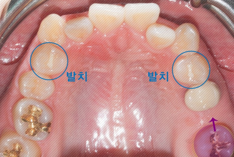 2D치과(투디치과) 돌출입 발치&덧니교정 후기 ft.크라우딩이란? 관련 이미지 5