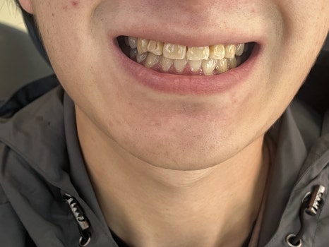 무삭제라미네이트 블랙필름 케이스 비포 에프터 후기 관련 이미지 12