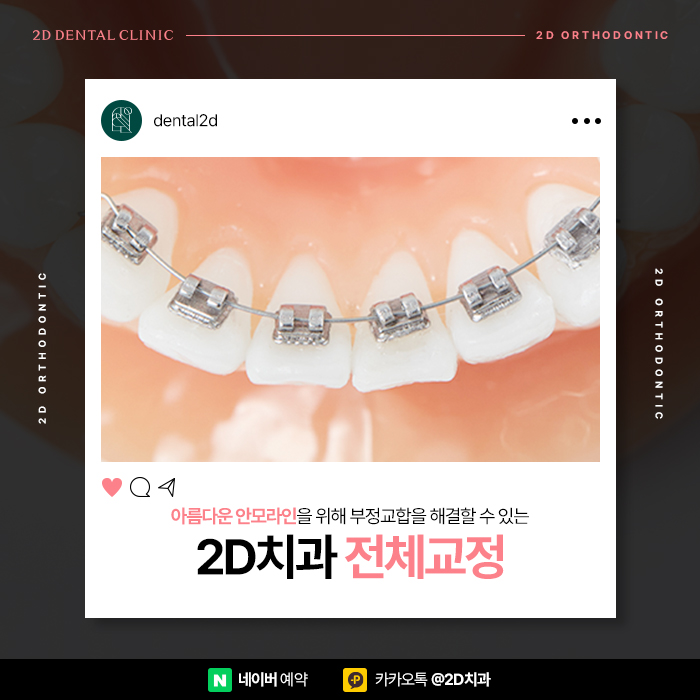 부정교합, 황금비율 안모 라인을 위한 신논현역 2D치과의 치아교정 관련 이미지 1